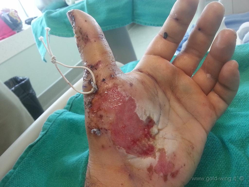 WP_20140814_024.jpg - La mano sinistra 5 giorni dopo l'incidente (14.8.2014)